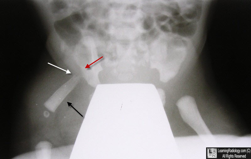 Proximal Femoral Focal Deficiency (PFFD)